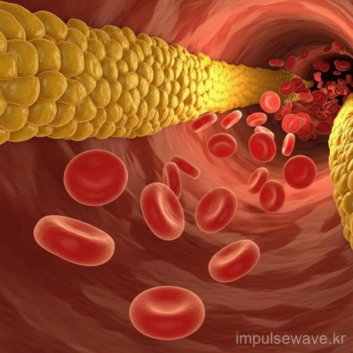 혈관 속에 쌓여있는 노란색 콜레스테롤 덩어리와 적혈구가 흐르는 3D 일러스트